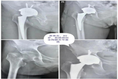 <b>汉滨区第一医院用上国家集采的髋膝关节</b>