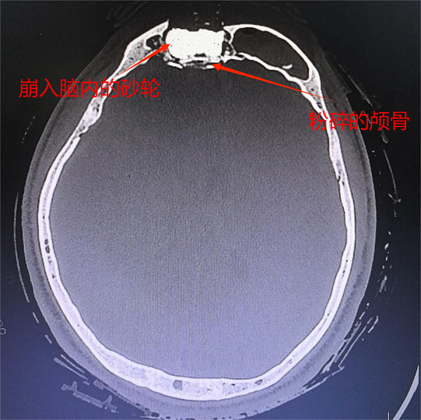 <b>金秋生命接力：多学科协作成功救治颅脑重伤少年</b>